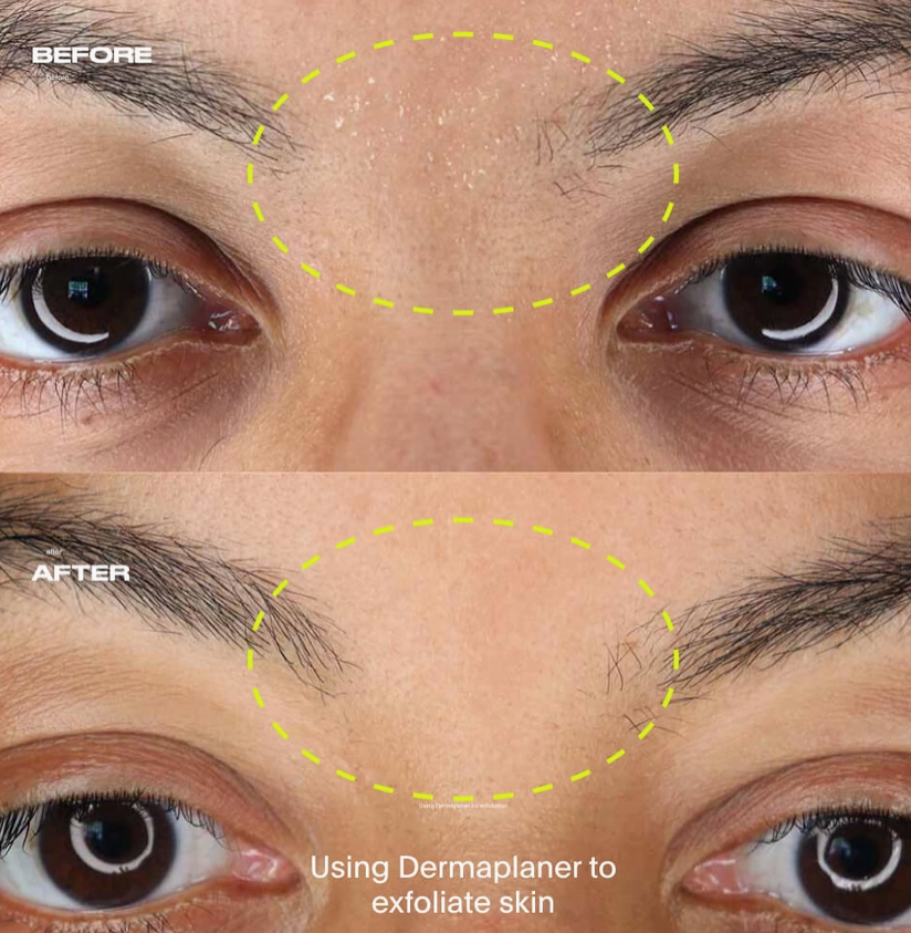 Dermaplaner