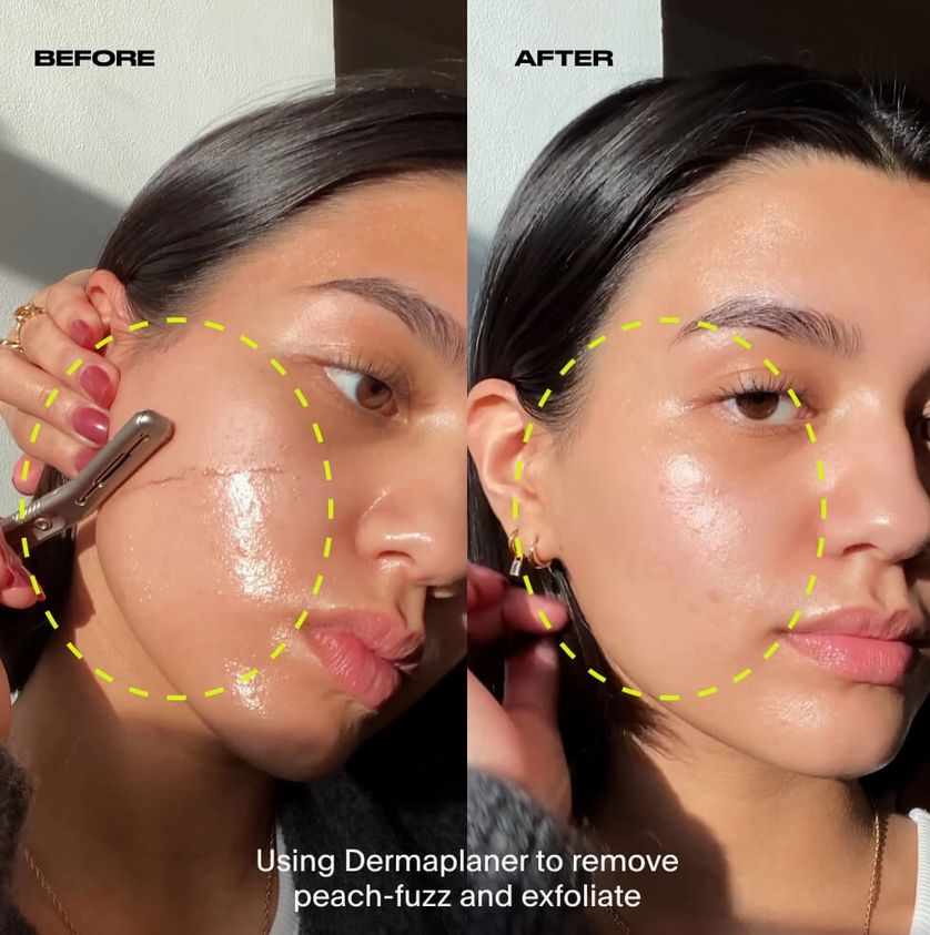 Dermaplaner